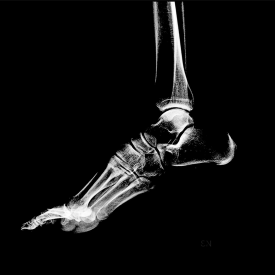 MRI Left Ankle Joint With Contrast